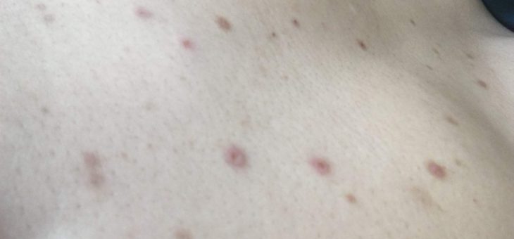 ８月１７日・土　かゆみと張り